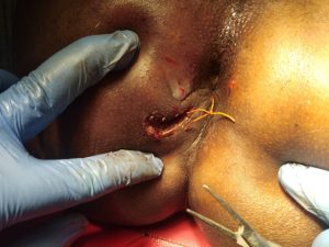 Anal Fistula Anal Fistula