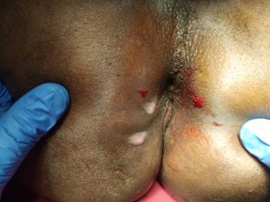 Treatment For Anal Fistula Treatment For Anal Fistula