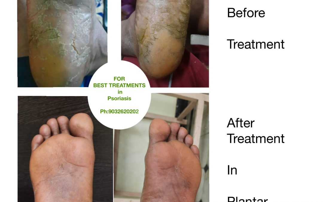 Plantar Psoriasis Before and After