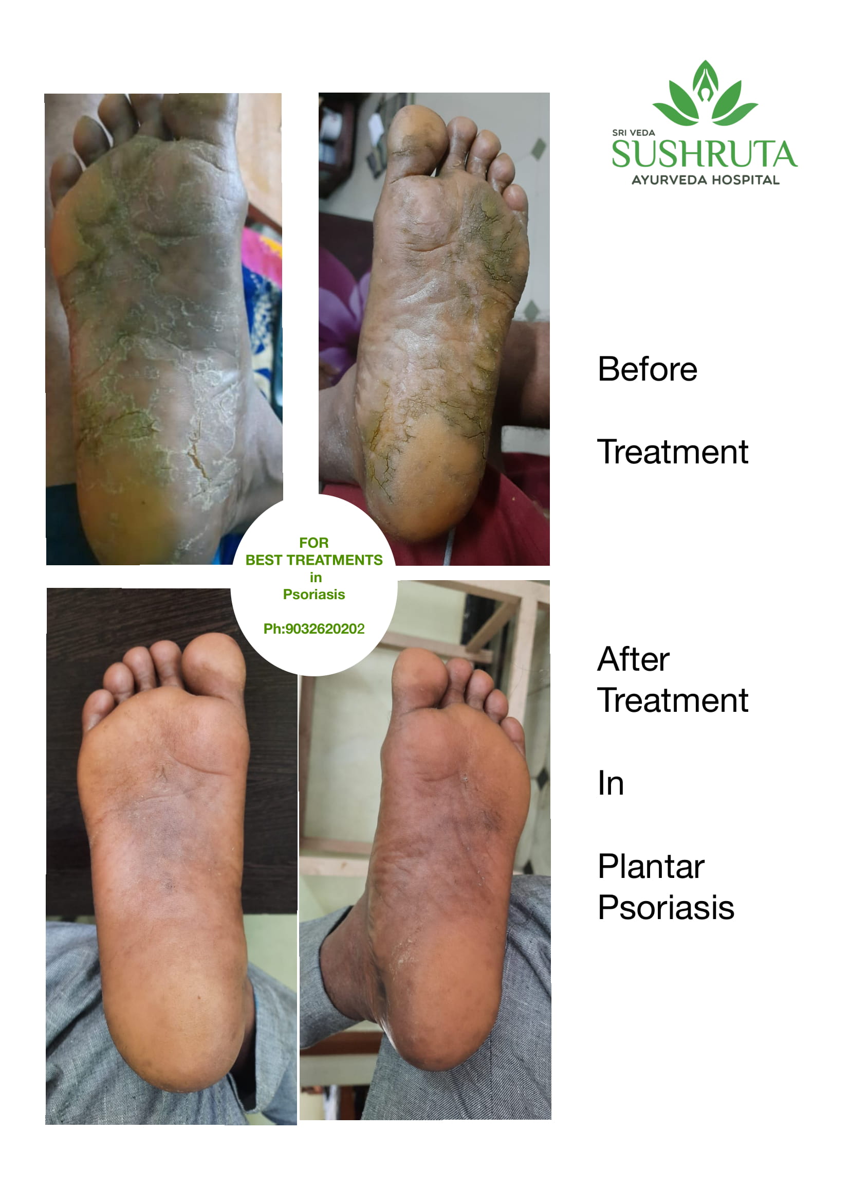 Plantar Psoriasis Before and After